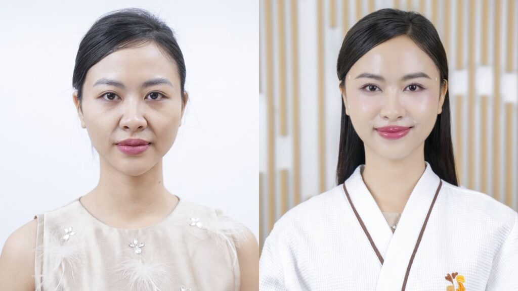 Minh Anh tạm biệt má hóp, thái dương trũng sau tiêm filler tại Kangnam