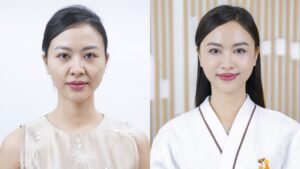 Minh Anh tạm biệt má hóp, thái dương trũng sau tiêm filler tại Kangnam