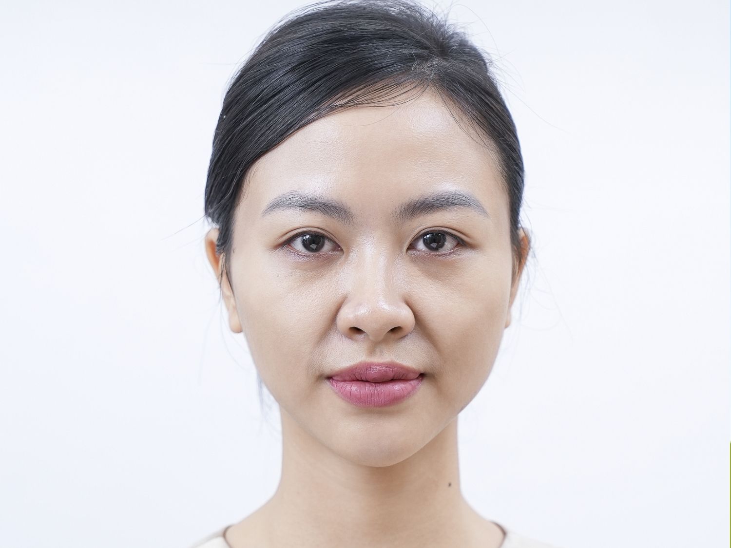 tình trạng da khách hàng Minh Anh trước khi tiêm filler, gương mặt nhiều rãnh sâu trông già nua