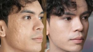 Phú lấy lại làn da mịn màng sau điều trị sẹo rỗ tại Kangnam