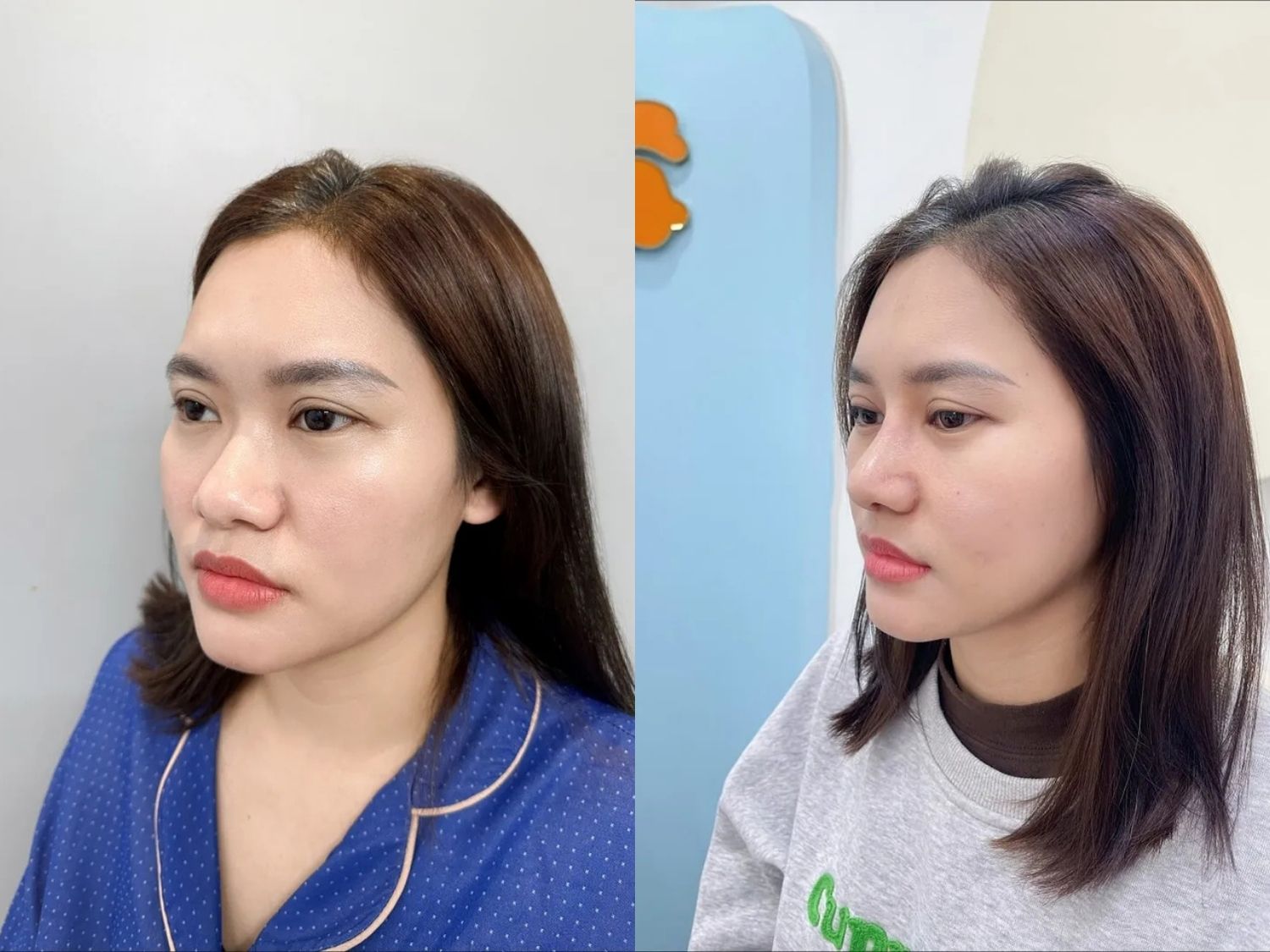 Phương Hằng trước và sau khi nâng mũi tại Kangnam, mũi thon gọn, hài hòa