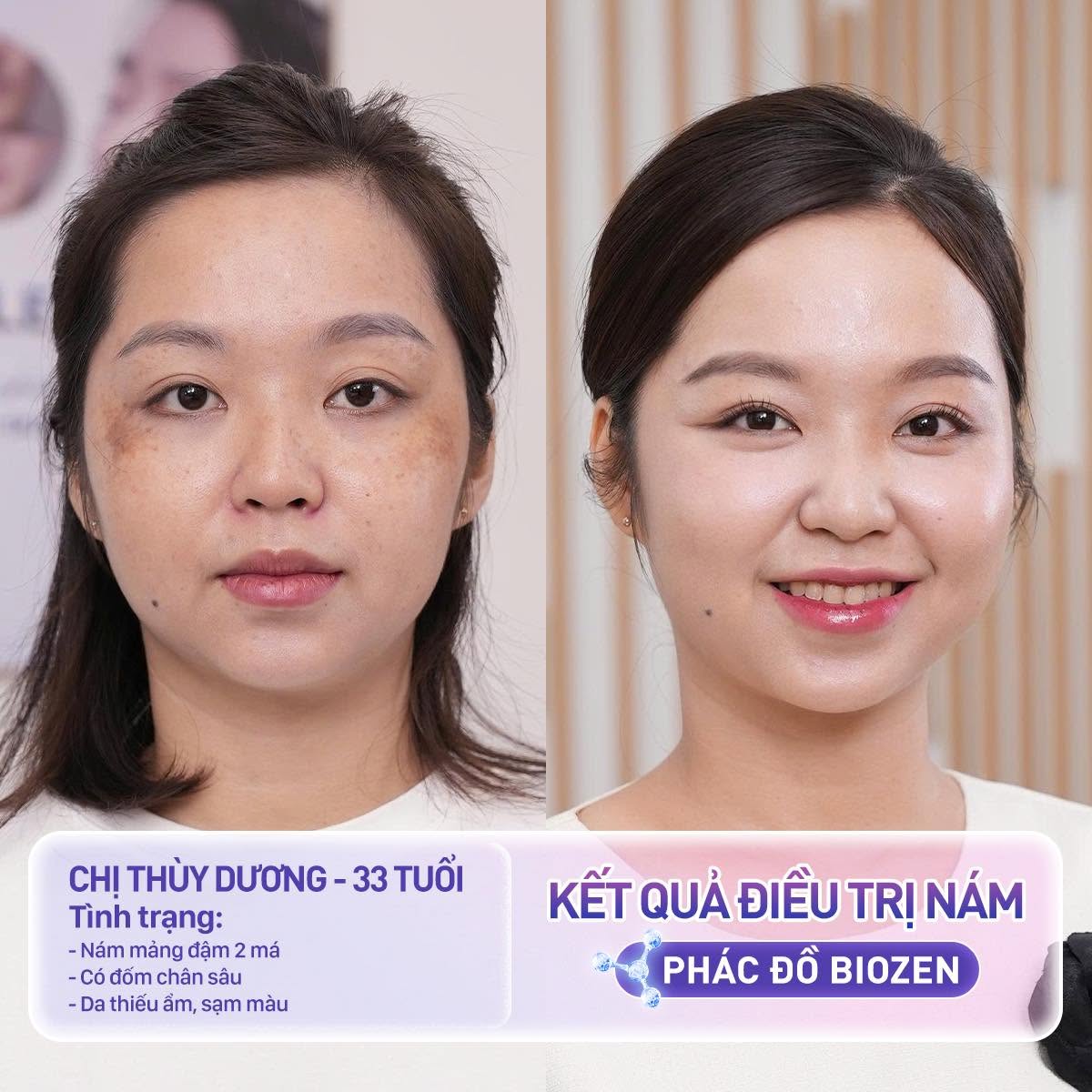 ảnh trước và sau của Dương thấy rõ Các mảng nám sạm màu ở hai bên má đã mờ đi rõ rệt, làn da đều màu và nâng tông sáng khỏe tự nhiên