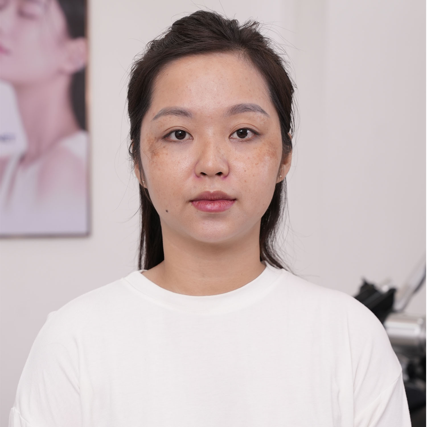 tình trạng da của Dương, nám Xuất hiện rõ rệt ở hai bên vùng má, phân bổ thành từng cụm