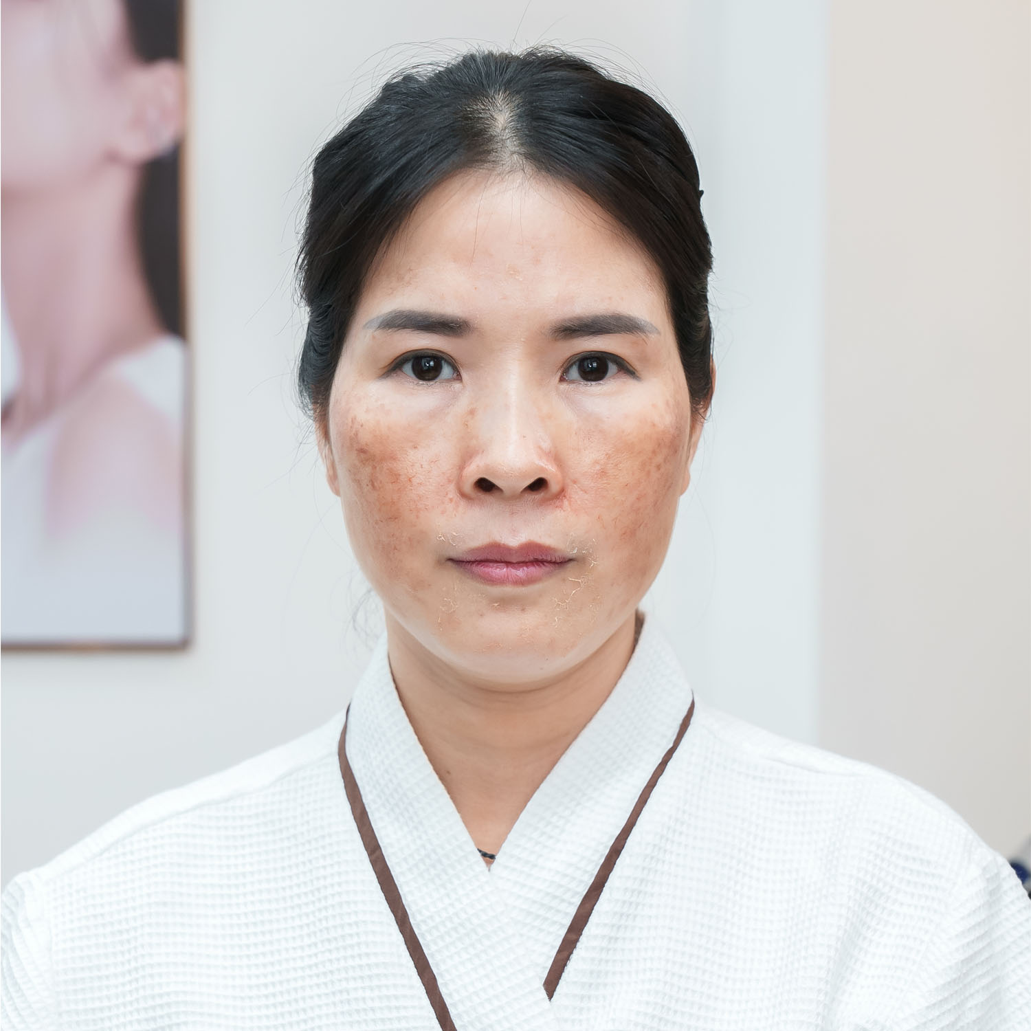 tình trạng của Vân Anh Nám mảng sau sinh diện rộng, Nền da tổn thương và mỏng yếu