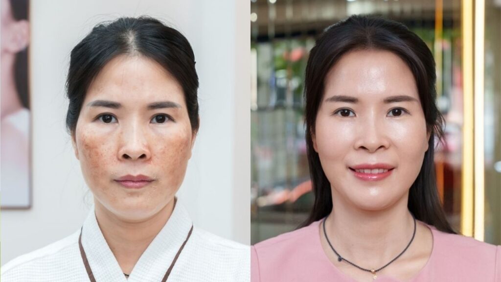 Vân Anh trị nám mảng sau sinh, phục hồi da mỏng yếu với phác đồ Biozen