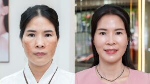 Vân Anh trị nám mảng sau sinh, phục hồi da mỏng yếu với phác đồ Biozen