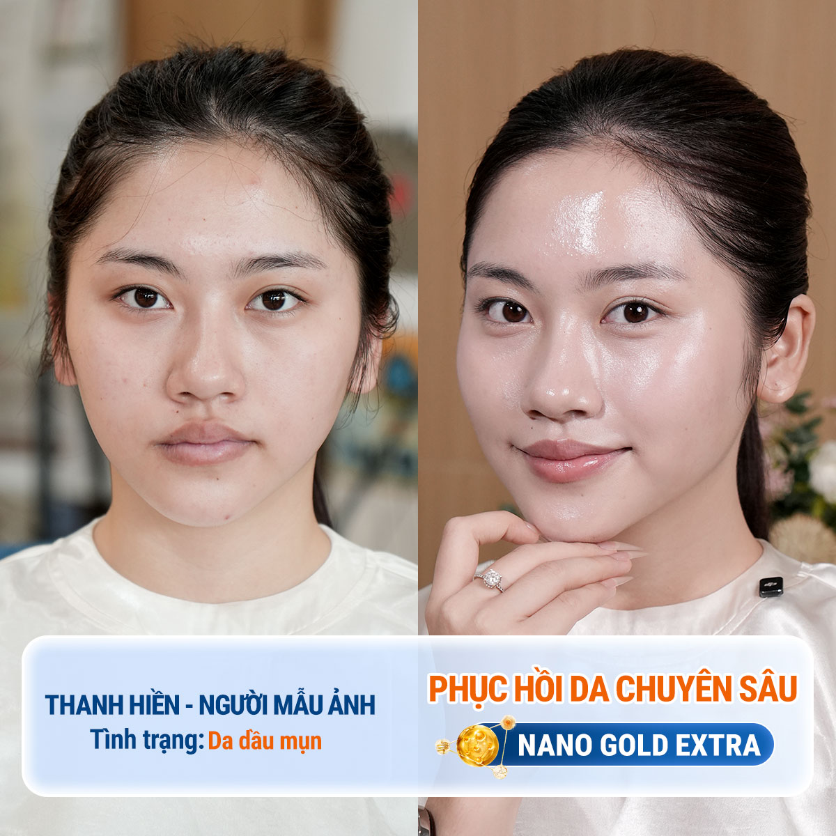 Làn da của Thanh Hiền như được phục hồi và tái tạo mạnh mẽ sau khi kết thúc liệu trình, da bóng khỏe