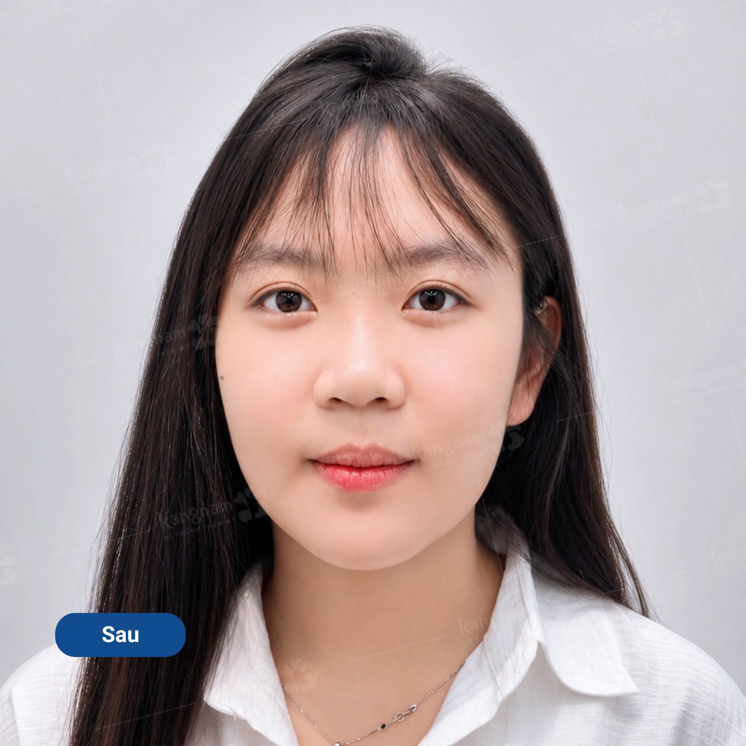 Tình trạng hàm dưới đưa ra trước và cằm chìa được cải thiện, đường nét khuôn mặt đã cân đối hơn