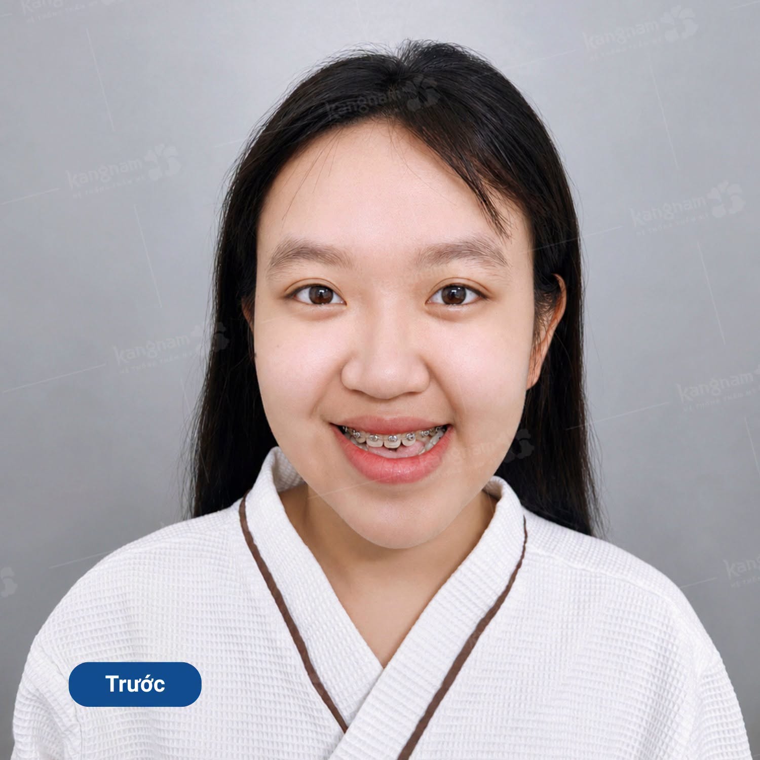 quỳnh như tình trạng khớp cắn ngược đi kèm móm do xương
