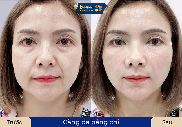 khách hàng có nhiều nếp nhăn rãnh cười, đuôi mắt. Sau khi căng da bằng chỉ sở hữu làn da căng mọng, trẻ trung