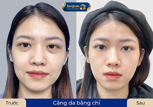 khách hàng lão hóa nhẹ, nếp nhăn quanh miệng, sau khi căng da bằng chỉ trẻ hơn đến 5 tuổi