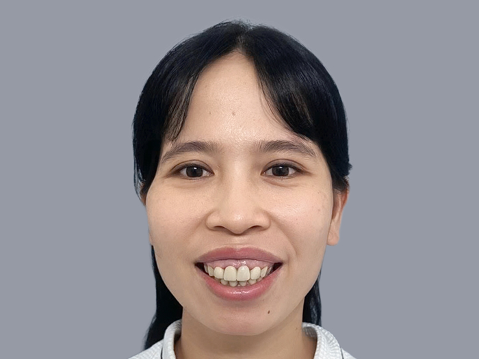 Khuôn miệng nhô ra trước, hàm trên và hàm dưới không tương quan đúng vị trí