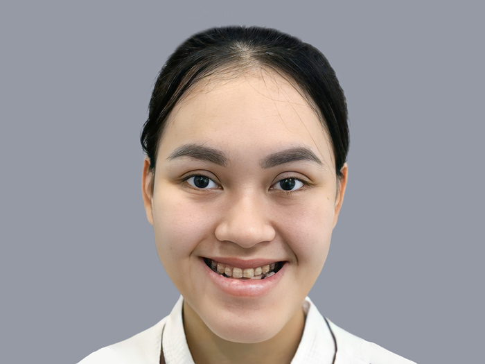 tình trạng hàm móm nặng, ảnh hưởng đến ăn nhai, phát âm, cần cân nhắc phẫu thuật