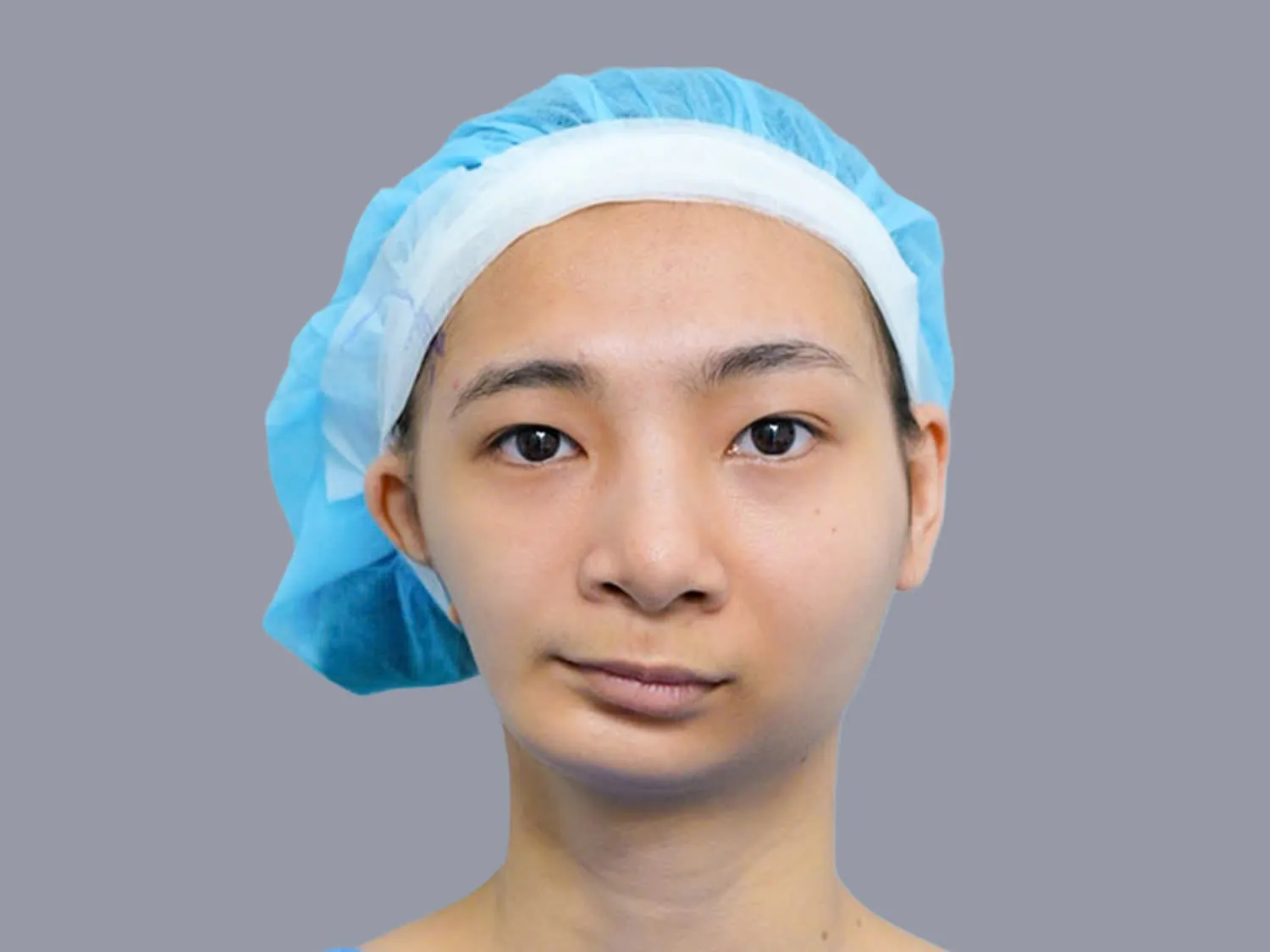 nhận biết mặt lệch, Đường nối từ đỉnh mũi, nhân trung đến cằm không tạo thành một đường thẳng