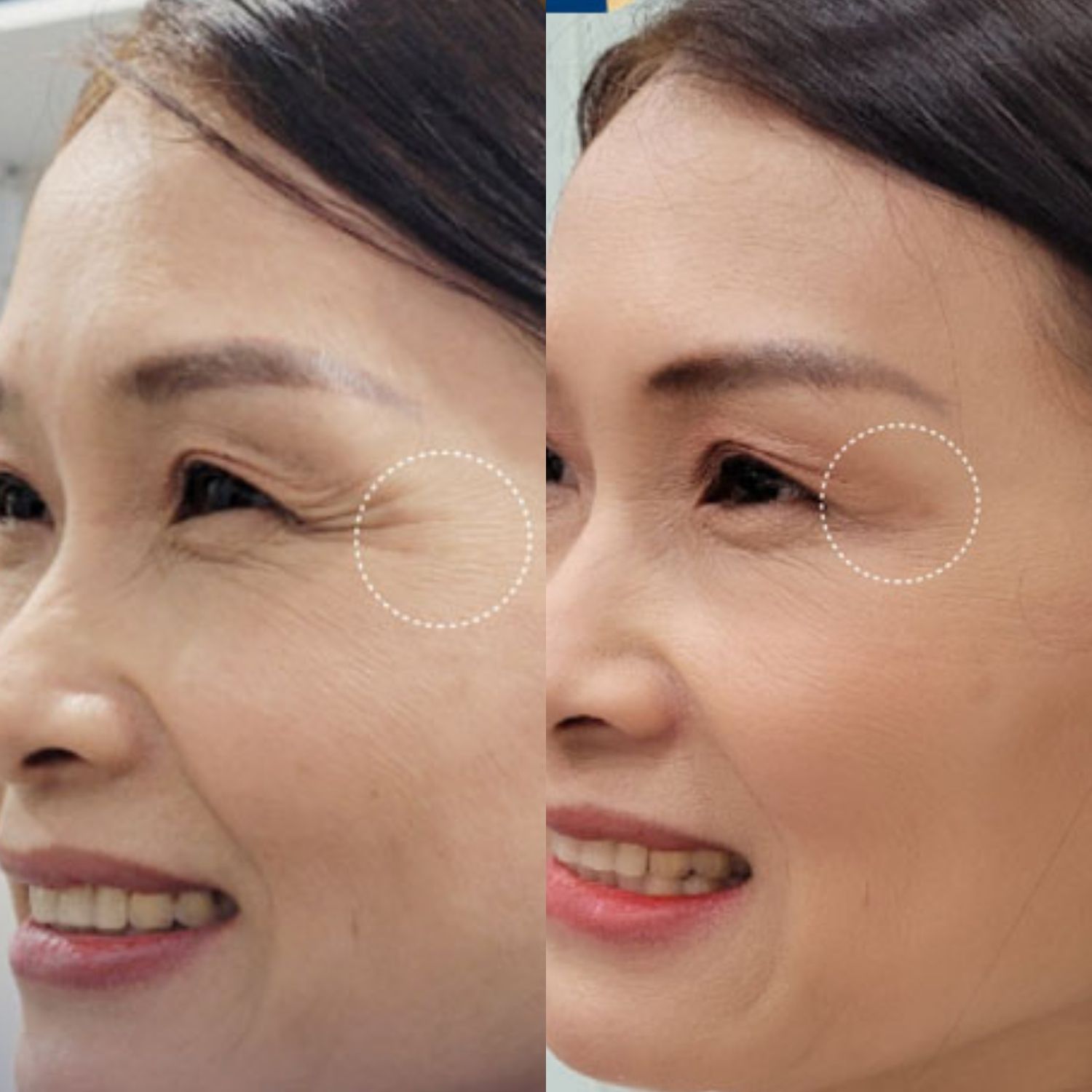 khách hàng bị nhăn đuôi mắt sau khi tiêm botox đã cải thiện nếp nhăn đáng kể, gương mặt trẻ hơn