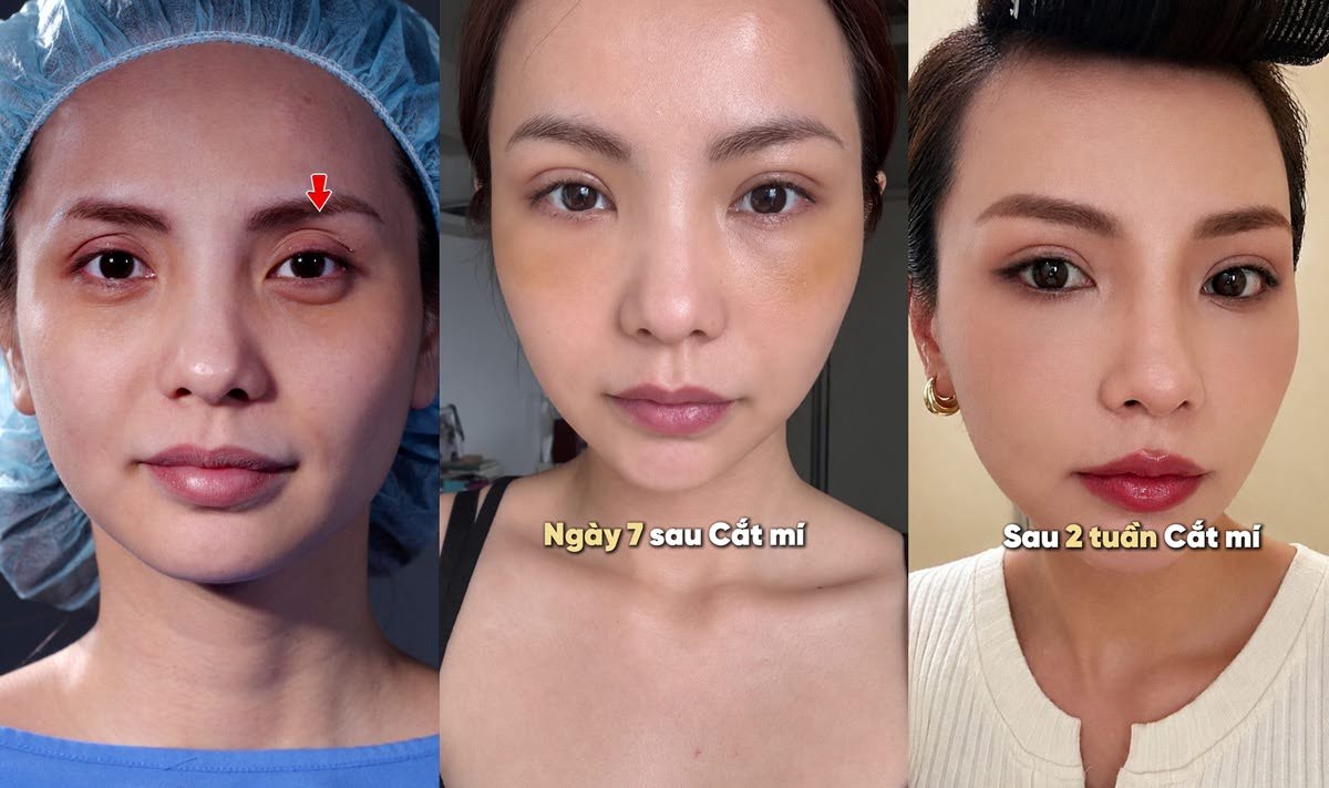 Bùi Linh Chi được thực hiện cắt mí 6D kèm các giải pháp kỹ thuật nhanh hồi phục tại Kangnam