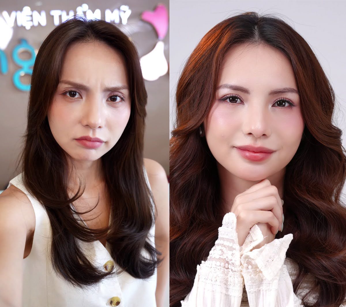 Bùi Linh Chi trở lại xuất sắc sau khi cắt mí tại Bệnh viện Thẩm mỹ Kangnam