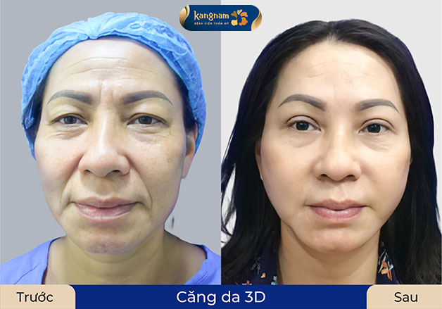 Khách hàng gặp tình trạng lão hóa nặng, sau khi phẫu thuật căng da trẻ hơn 5 tuổi, da căng mịn, tự nhiên