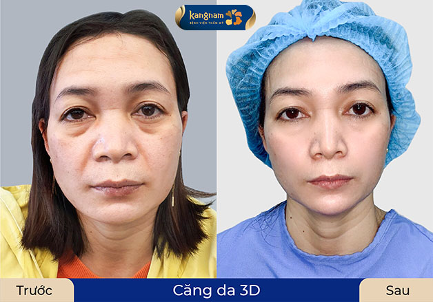 khách hàng lão hóa nặng, nhiều nếp nhăn tĩnh. Sau khi phẫu thuật căng da mặt gương mặt trẻ hơn 5 tuổi , da căng mịn tự nhiên
