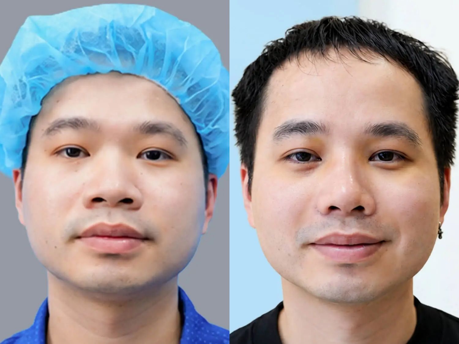 Việt kiều Evan Lê trước và sau khi nâng mũi cấu trúc tại Kannam, gương mặt trẻ trung và nam tính hơn