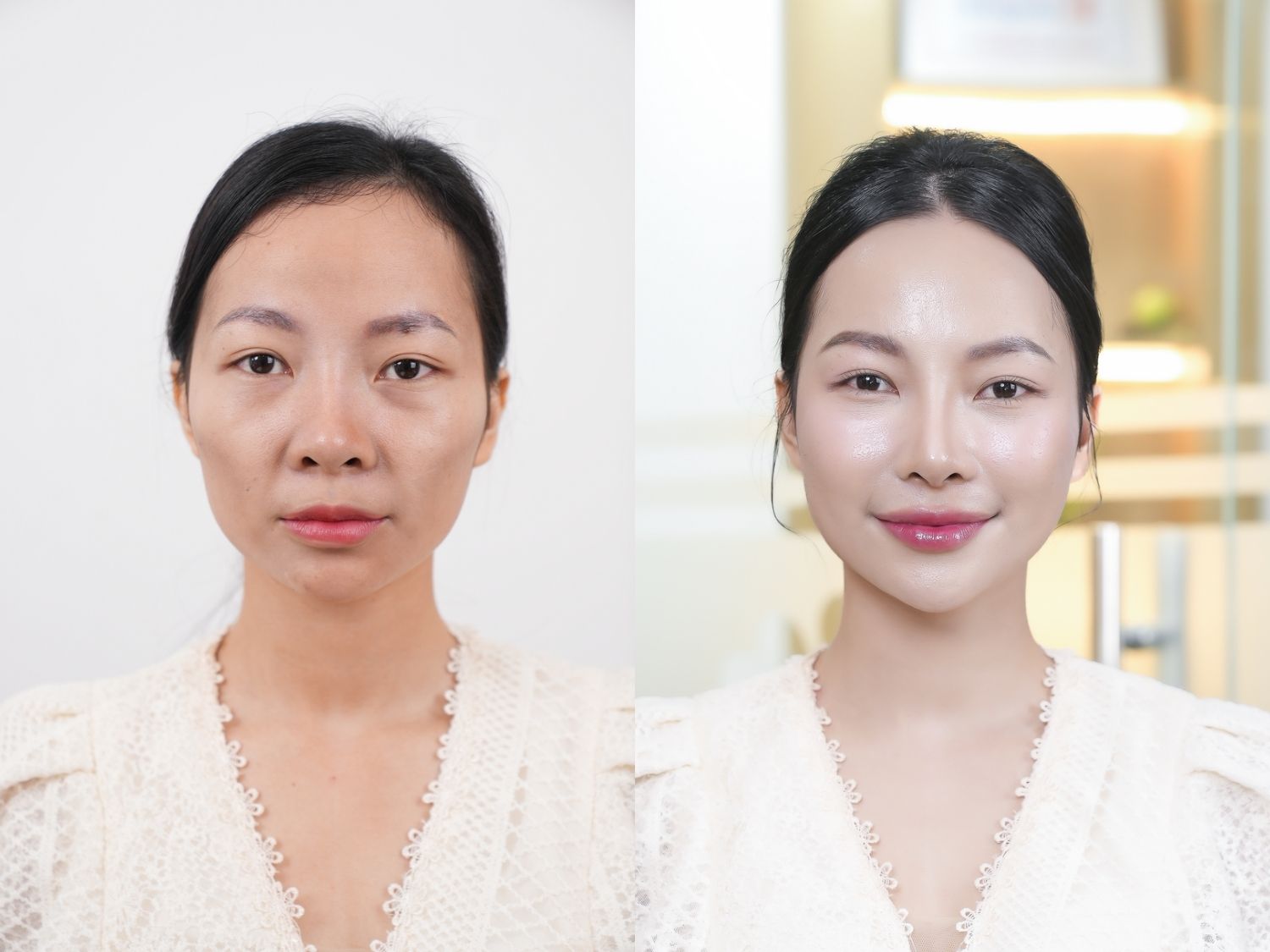 khách hàng có má hóp, rãnh cười, sau khi tiêm filler gương mặt trẻ trung hơn