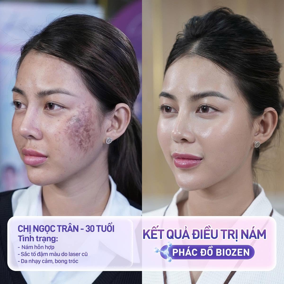 Ngọc Trân, 30 tuổi, bị nám hỗn hợp diện rộng, tăng sắc tố sau viêm và da mỏng yếu. Sau liệu trình trị nám, tình trạng nám hỗn hợp và tăng sắc tố được cải thiện rõ rệt