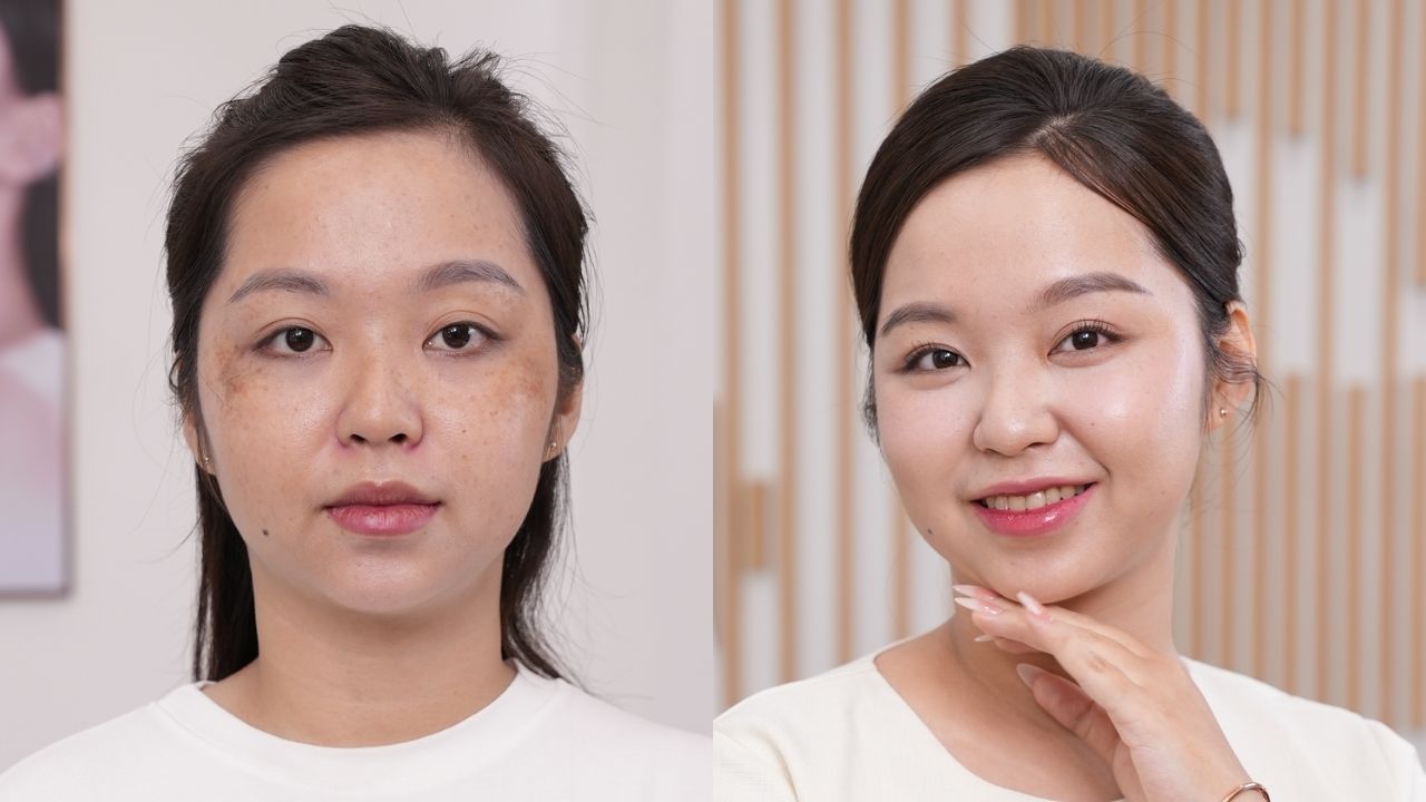 Thùy Dương xóa nám thành công với phác đồ Biozen tại Kangnam. Ảnh so sánh trước sau cho thấy tình trạng nám cải thiện đáng kể