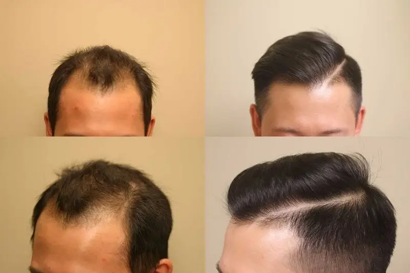 trường hợp rụng tóc nhiều, hói chữ M, thực hiện cấy tóc để sở hữu kết quả vĩnh viên, cải thiện tóc chắc khỏe và đều