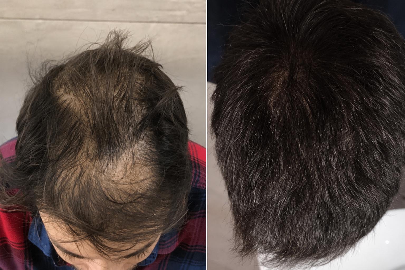 khách hàng trước và sau khi cấy tóc tại Kangnam. tóc dày khỏe tự nhiên sau khi cấy và mọc ổn định