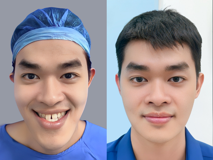 ảnh trước và sau khi Phẫu thuật chỉnh hàm lệch của khách hàng