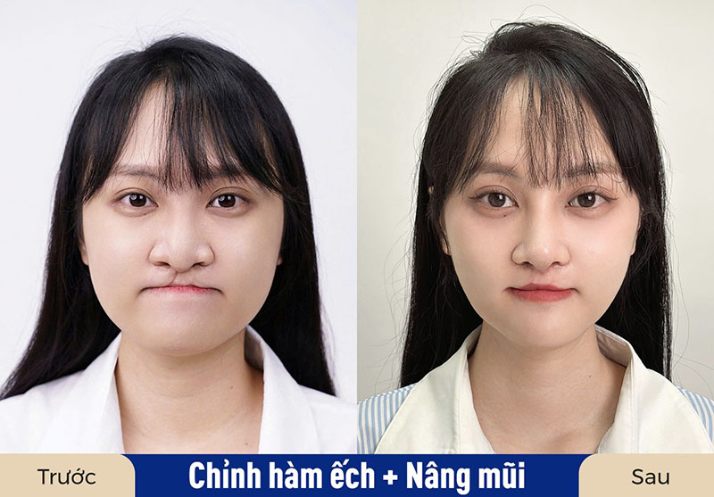Minh Xuân bị sứt môi hở hàm ếch bẩm sinh, hàm trên kém phát triển. Sau quá trình điều trị, tình trạng móm, lệch hàm và mất cân đối gương mặt được cải thiện rõ rệt
