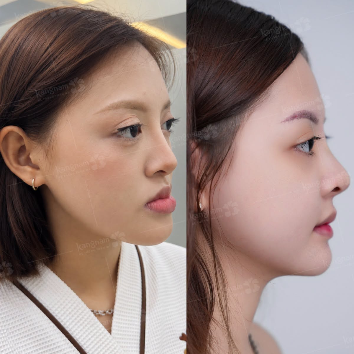 khách hàng hồi phục tốt sau khi điều chỉnh khớp cắn ngược. Kết quả 2 hàm cân đối