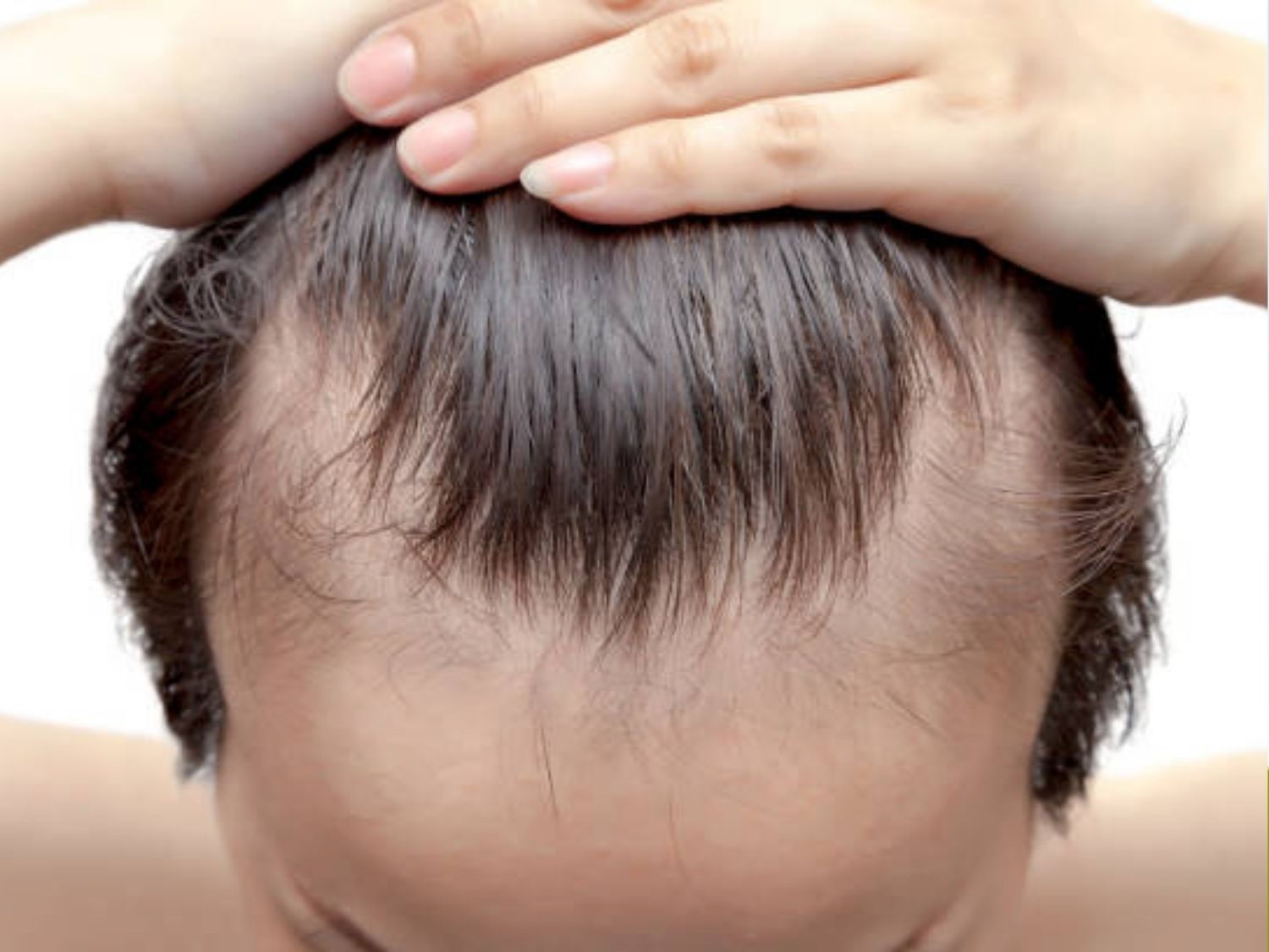 tình trạng hói đầu tạo thành chán chữ M thường gặp ở nam giới