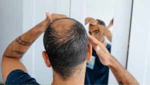 Điều trị hói đầu: Nguyên nhân, phương pháp hiệu quả và giải pháp phục hồi tóc