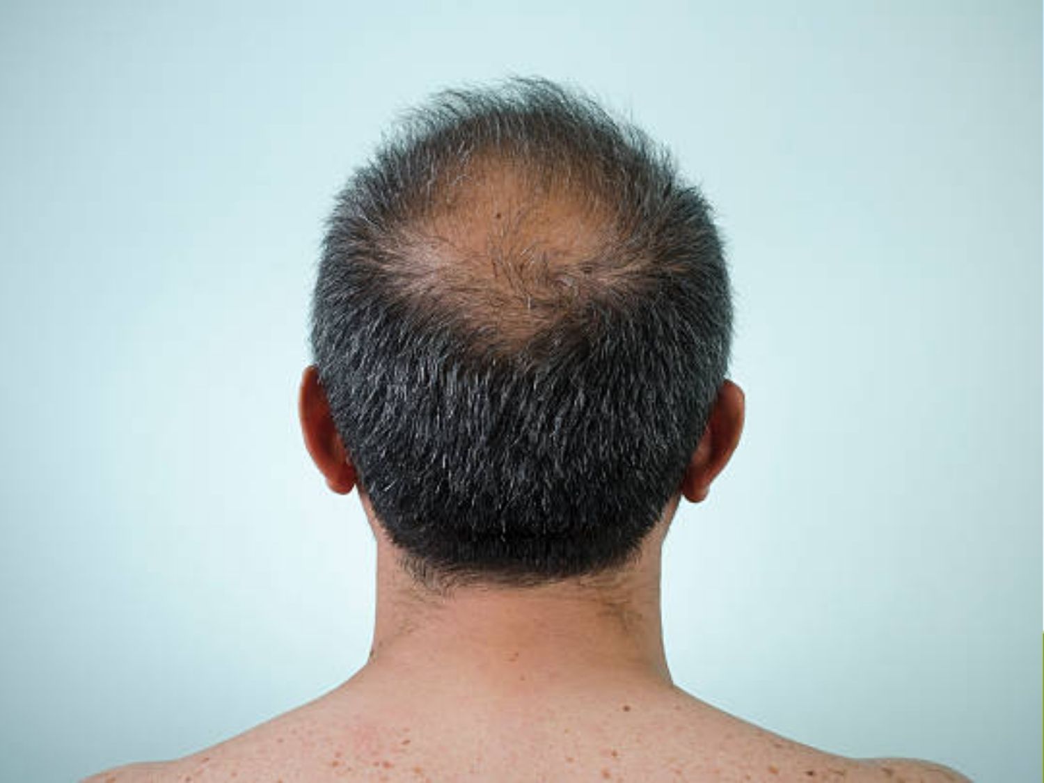 tình trạng hói nhiều, khiến người gặp phải tự ti nên cân nhắc điều trị