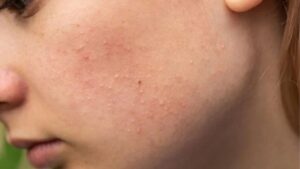 Điều Trị Mụn Ẩn Chuẩn Y Khoa: Nguyên Nhân, Phác Đồ Và Cách Chăm Sóc Sạch Sâu