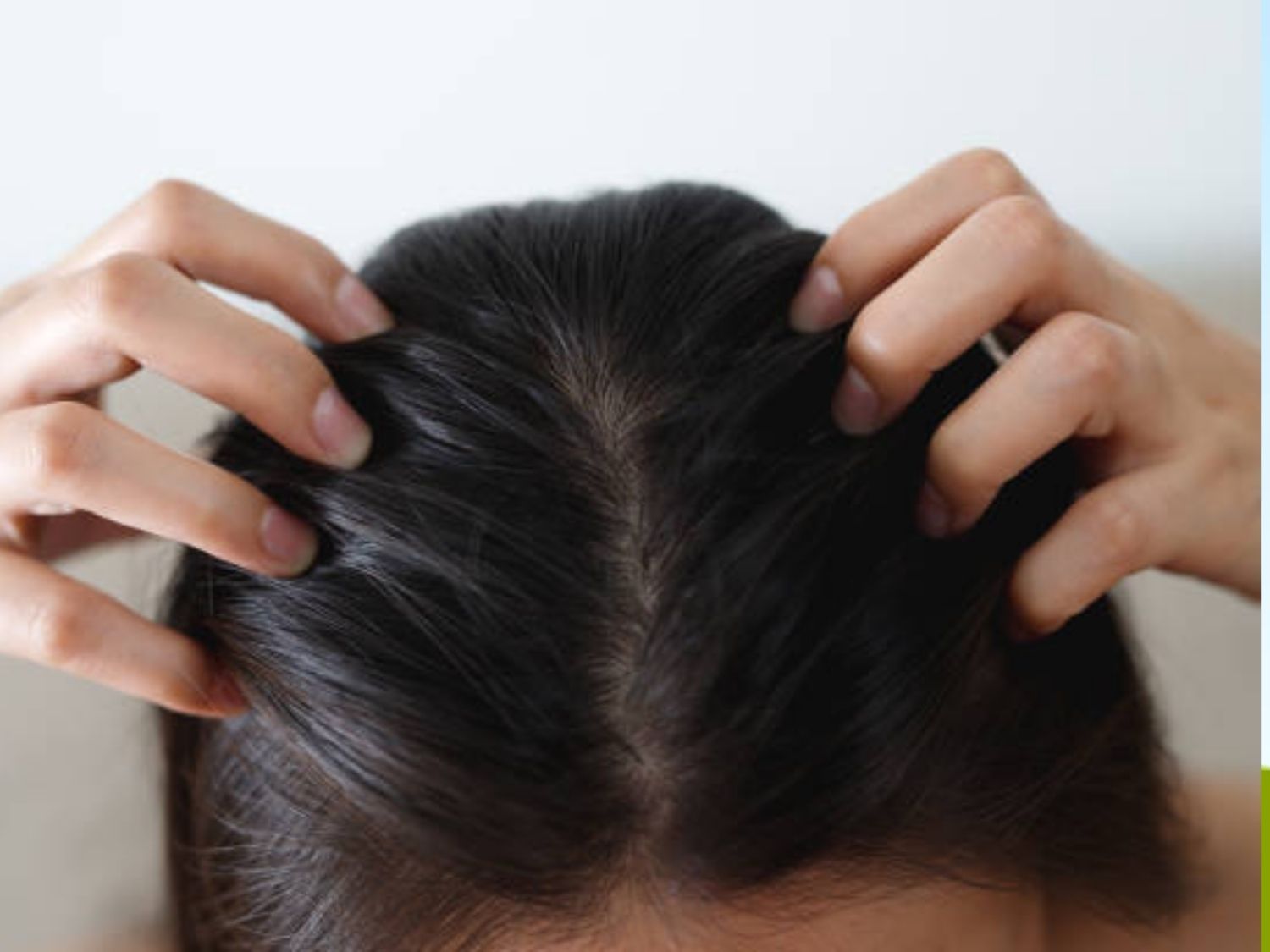 tóc rụng kèm ngứa da đầu gây tình trạng khó chịu