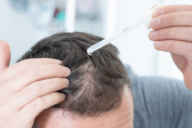 nam giới sử dụng Minoxidil điều trị rụng tóc tại nhà