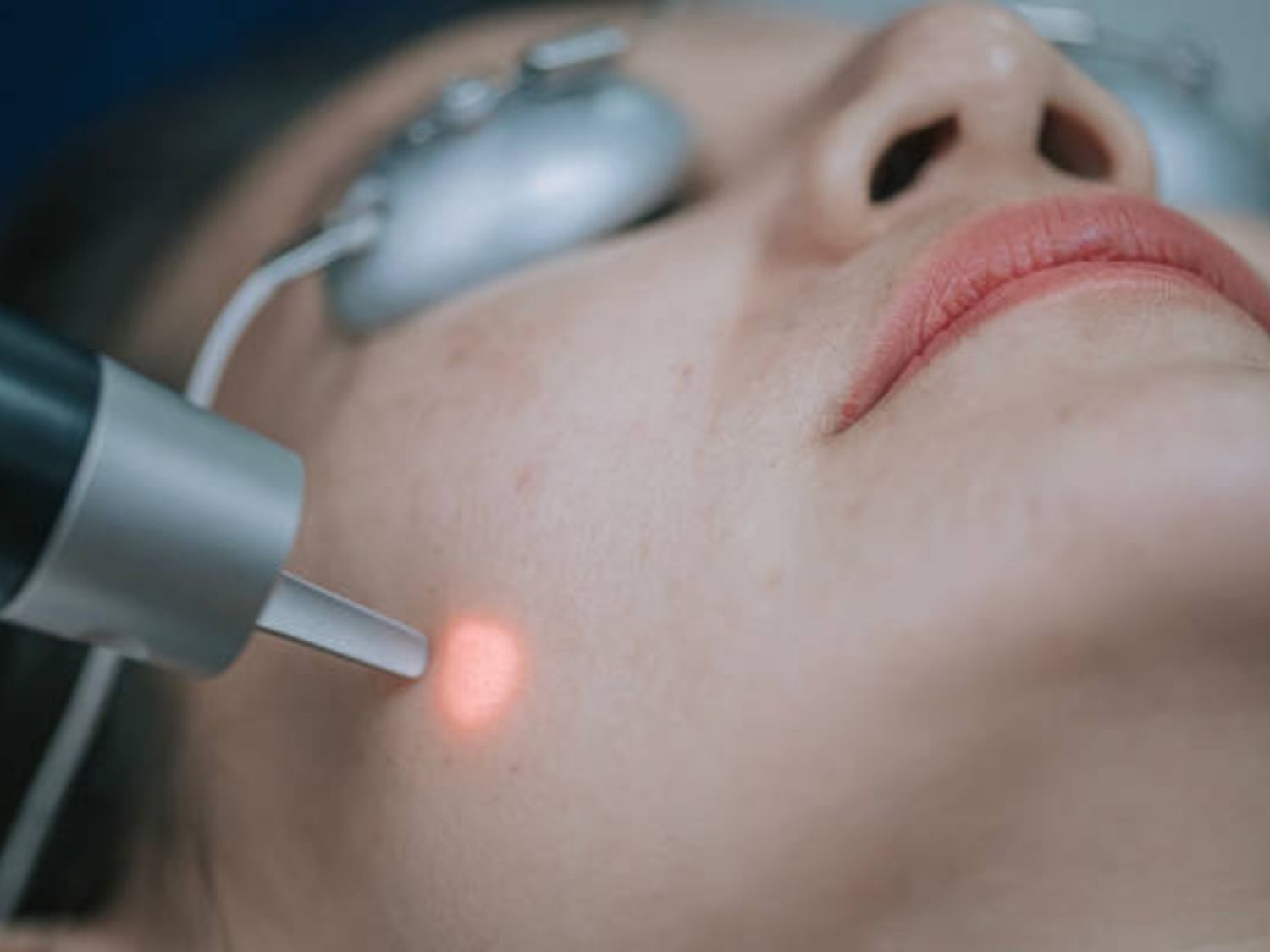 phương pháp chiếu tia laser điều trị sắc tố da hiệu quả, áp dụng tại nhiều cơ sở thẩm mỹ