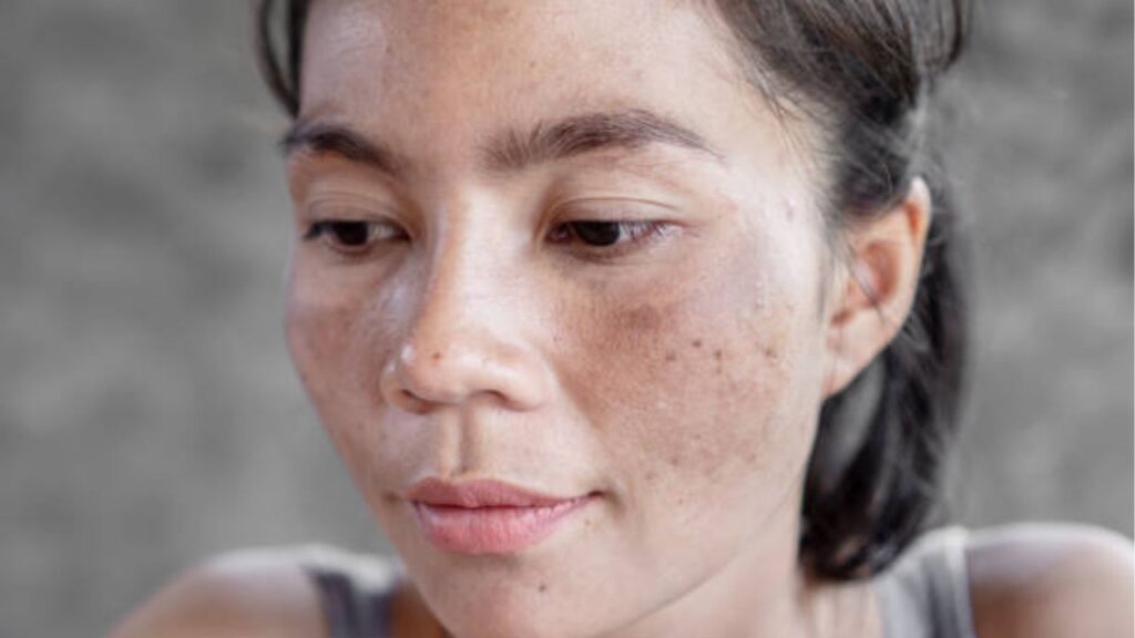 Điều trị sắc tố da: Phương pháp cải thiện nám, tàn nhang, thâm sạm hiệu quả