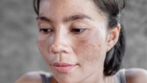 Điều trị sắc tố da: Phương pháp cải thiện nám, tàn nhang, thâm sạm hiệu quả