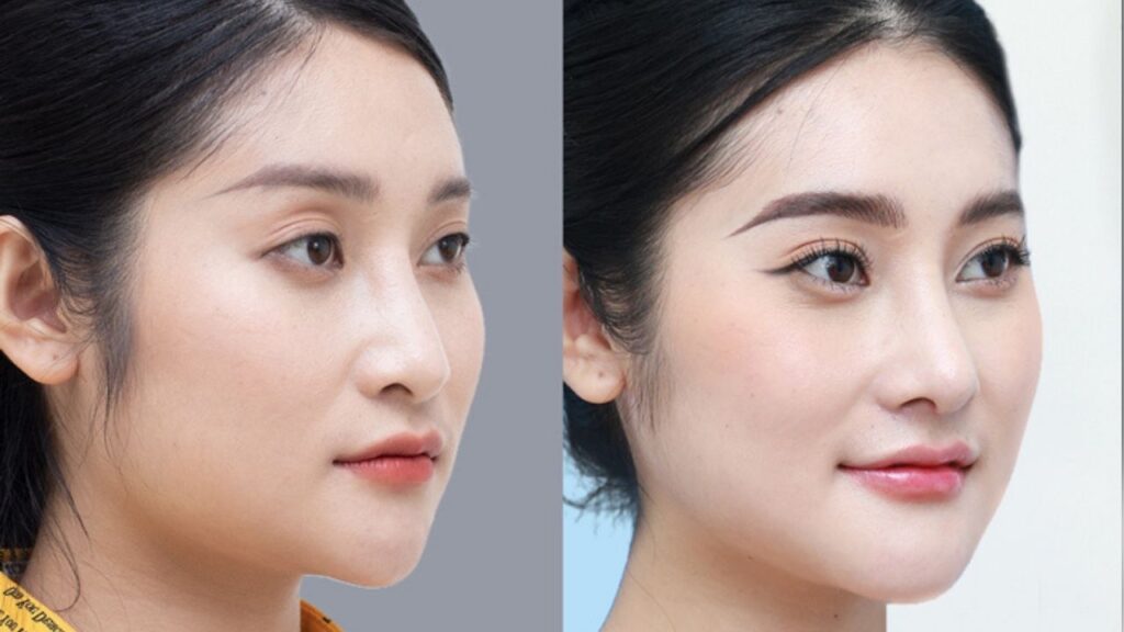Gọt Hàm Là Gì? Tất Tần Tật Về Phẫu Thuật Thu Gọn Góc Hàm V-Line