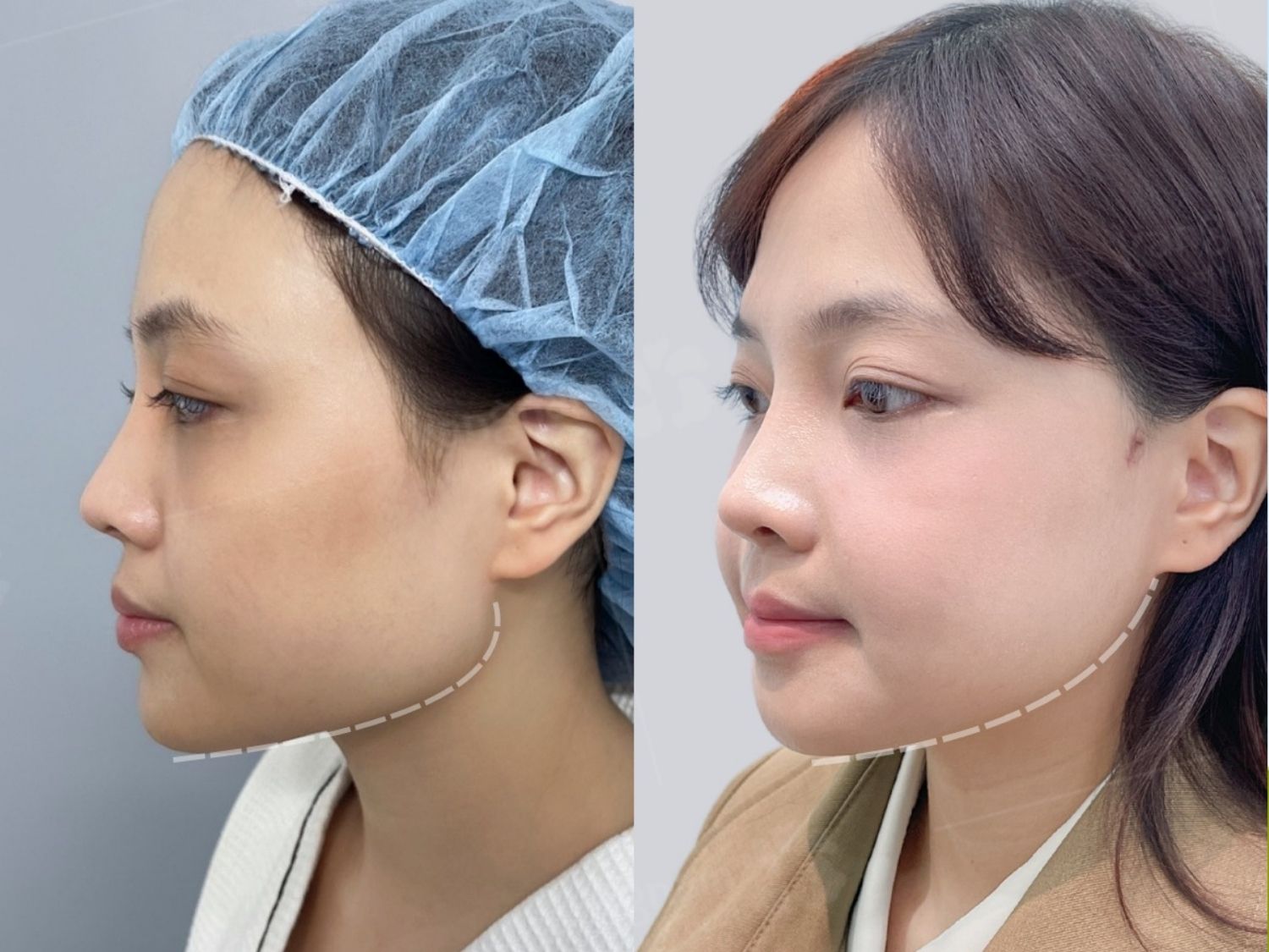 Góc hàm phì đại, bạnh vuông, góc hàm phát triển rộng sang hai bên