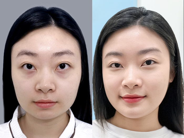 Yến Nhi có xương hàm vuông, to bạnh, sau phẫu thuật hàm đã thon gọn rõ rệt, cằm cân đối và có điểm nhấn hơn