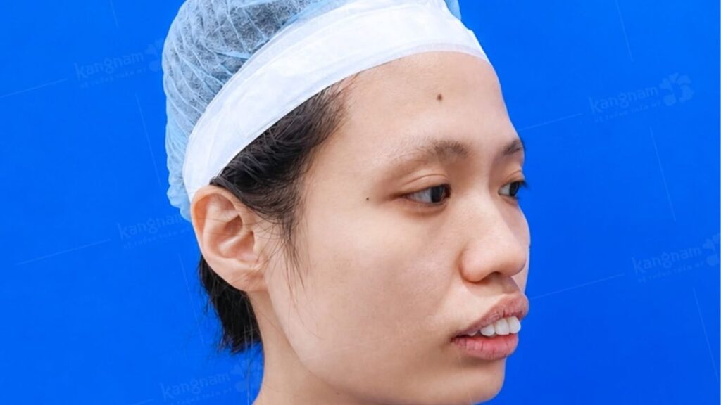 Hàm hô do xương là gì? Cách nhận biết và cải thiện hàm hô