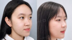 14 ngày thay đổi góc nghiêng: Hành trình Quỳnh Như tạm biệt khớp cắn ngược sau chỉnh hàm
