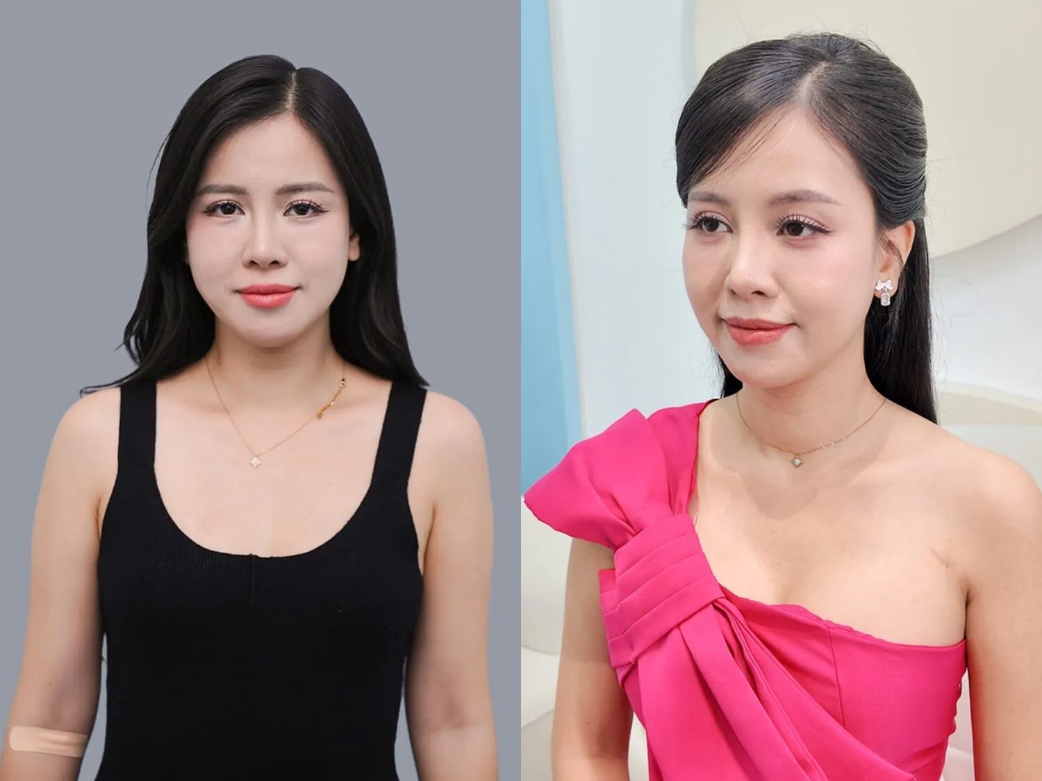 Ca sĩ – MC Bùi Hoàng Yến gặp tình trạng ngực bên to bên nhỏ. sau nâng ngực, vòng 1 của Hoàng Yến đã dần gom form, đầy đặn và cân đối hơn, cải thiện rõ tình trạng ngực bên to bên nhỏ ban đầu