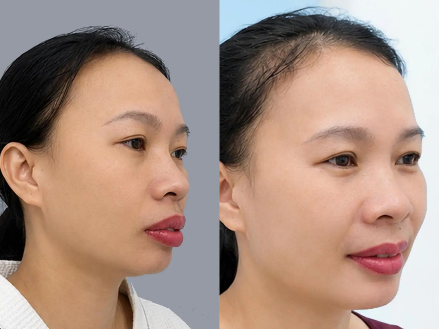 Chị Hồng Thanh có cằm lẹm, thiếu độ nhô và lùi sâu về phía sau, Sau 20 ngày, cằm có độ nhô và chiều dài cân đối hơn