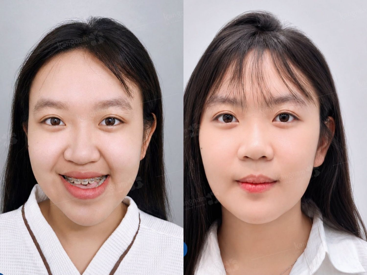ảnh so sánh sự thay đổi của Quỳnh Như