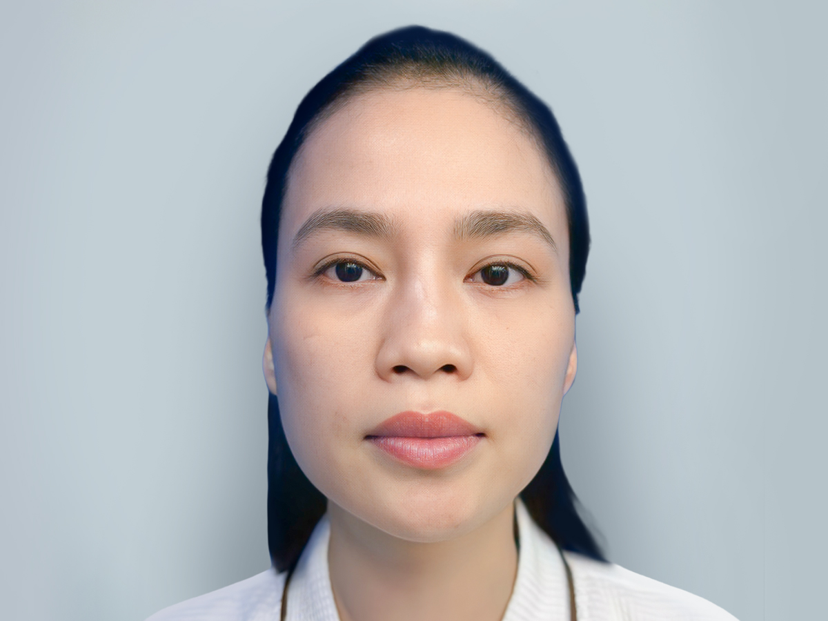 mũi gãy, hỏng do sử dụng sụn không phù hợp ở lần nâng mũi trước đó khiến mũi biến dạng
